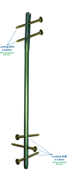 DAKSH Humerus Nail
